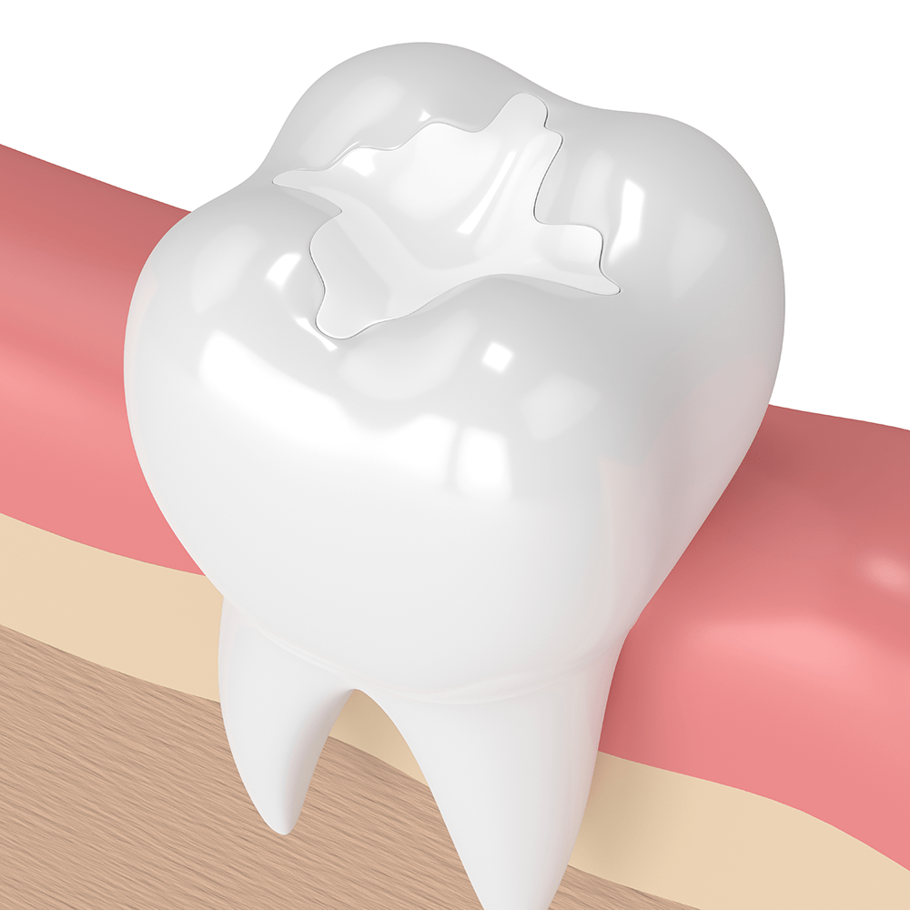 Selamatkan Gigi Anda dgn Endodontik